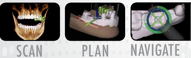 Lifeport Maps Navigation Implant Surgery - Casemasters Blog